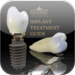 Implant Treatment Guide